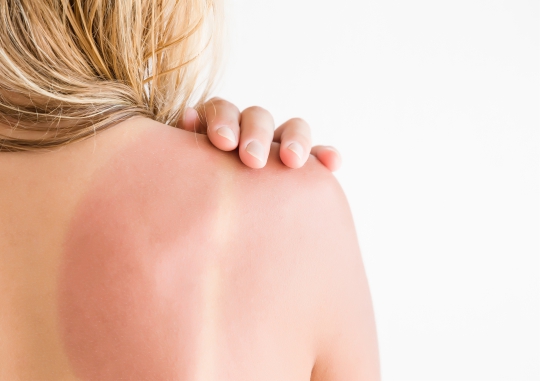 Woman with sunburn on her shoulders